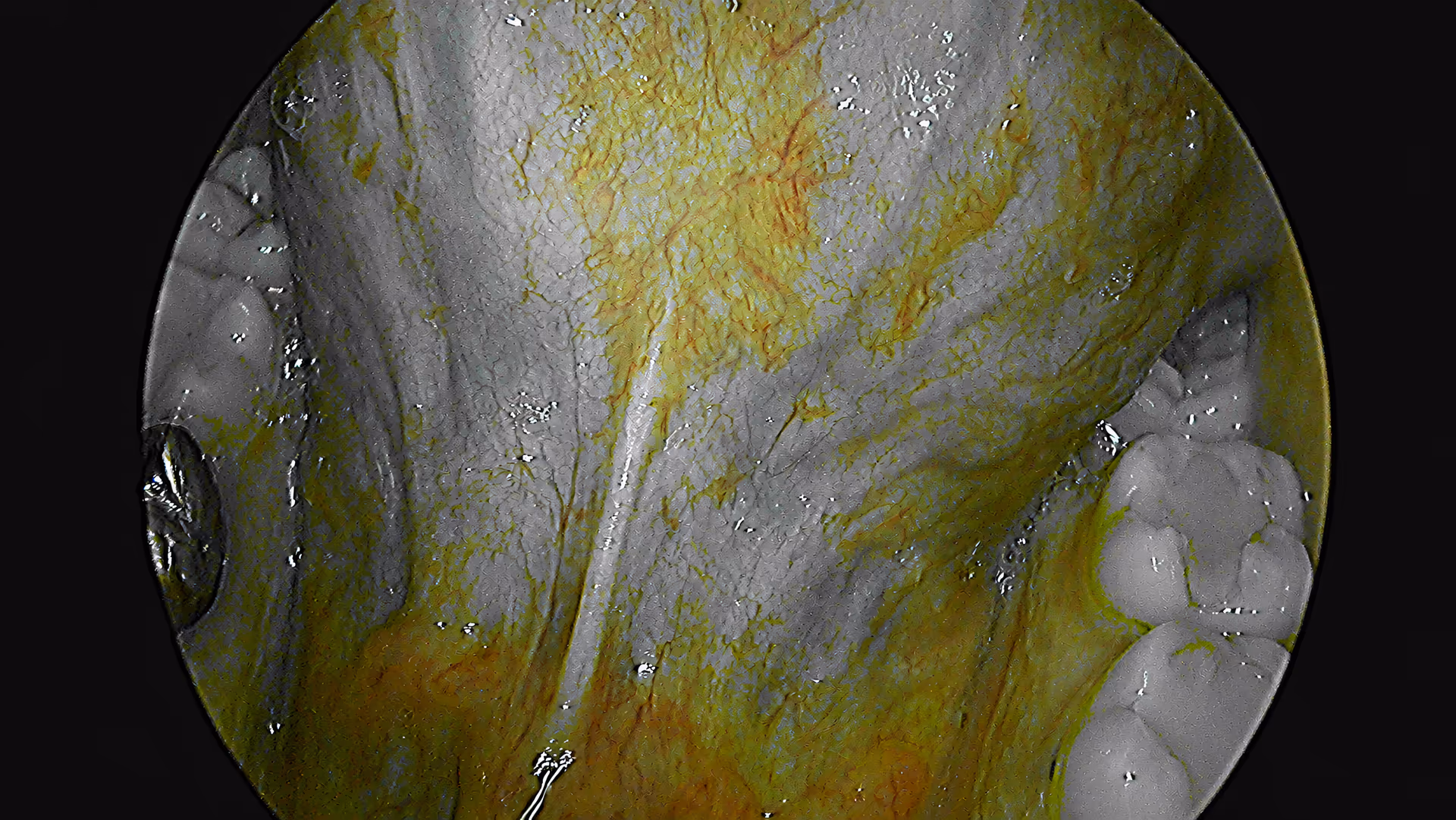 Two-tone BioMIS™ visualization highlighting superficial and deeper vascular structures