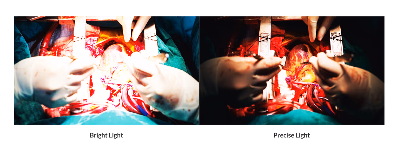 Side-by-side comparison of overexposed bright surgical lighting versus precise Celesta illumination with readable tissue colour and depth