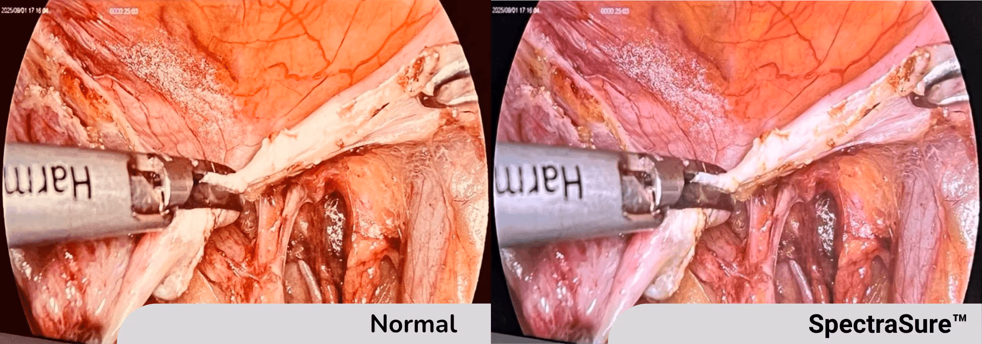 Side-by-side surgical view comparing normal illumination with SpectraSure high-fidelity colour on Constella