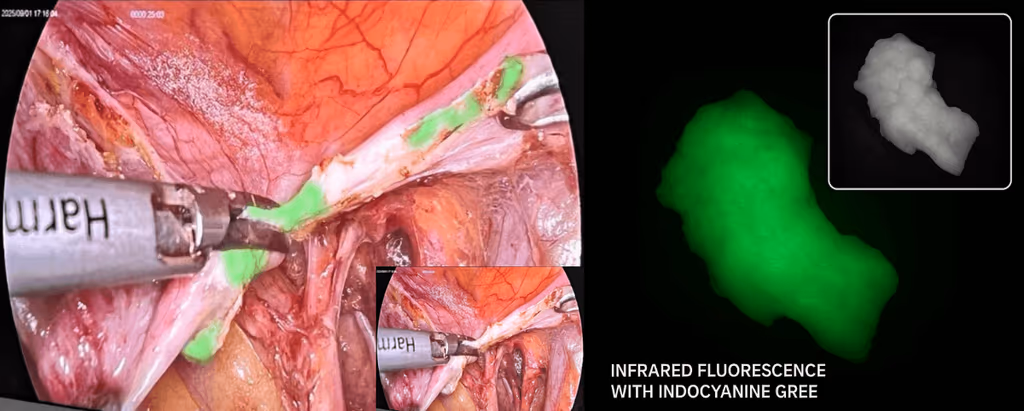 ICG fluorescence workflow with IRLA light source